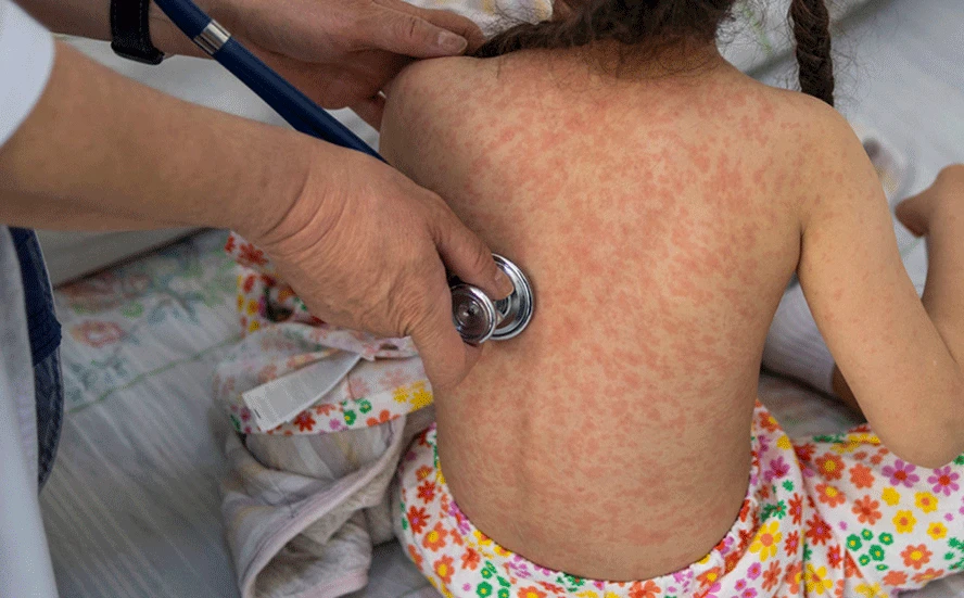Confirman cerca de 4 mil casos de sarampión en México