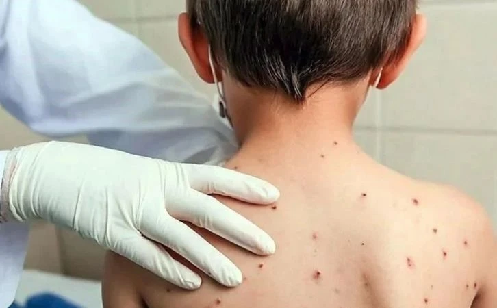 México acumula más de 11 mil casos de sarampión